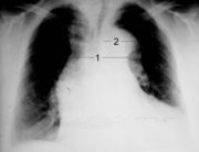 Röntgenaufnahme der Thoraxorgane mit verbreitertem1 Mediastinum und2 Aortenknopf