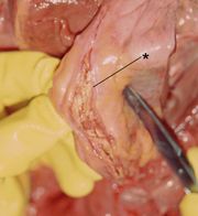 Aortendissektion: Anatomisches Präparat eines Aneurysma dissecans