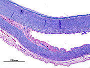 Spaltung der Wandschichten:histologisches Präparat eines Aneurysma dissecans