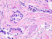 Histologisches Bild eines invasiven duktalen Karzinoms („szirrhöses Karzinom“)