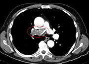 Lungenembolie mit Nachweis eines großen Thrombus innerhalb der rechten Pulmonalarterie