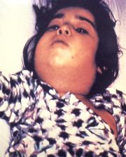 Kind mit geschwollenem Hals aufgrund der Entzündung