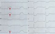 EKG bei akutem Hinterwandinfarkt. Die Pfeile weisen auf deutliche ST-Strecken-Hebungen in den Ableitungen II, III und aVF.