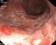 Endoskopiebild bei M. Crohn Pflastersteinrelief im terminalen Ileum