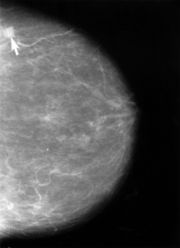 Ein Karzinom in der Mammographie