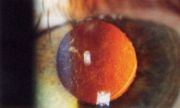 Trübung der hinteren Kapsel, regeneratorisch, hier bei medikamentös geweiteter Pupille im rückläufigen Strahlengang als helle und dunkle Konturen im rotorangenen Licht sichtbar.