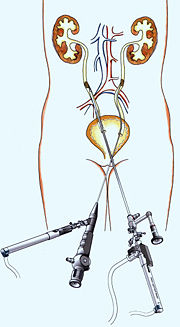 Entfernung von Harnleitersteinen mit dem Endoskop