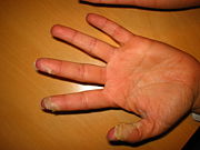 Schuppung der Haut an den Fingerkuppen