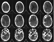 CCT-Untersuchung bei einem Patienten mit einem ischämischen Schlaganfall in der linken Gehirnhälfte (Versorgungsgebiet der Arteria cerebri anterior und Arteria cerebri media).