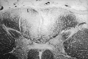 Die Entmarkung des Rückenmarks bei Tabes dorsalis in einem Myelin-gefärbten Präparat