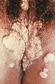 Condylomata lata der Vulva