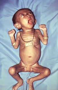 Weiblicher Säugling mit typischem Keuchhustenanfall. Man beachte die vorgestreckte Zunge.