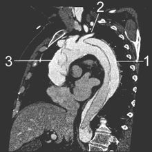CT einer Aortendissektion1 Aorta descendens mit Dissektion2 Linke Schlüsselbeinarterie3 Aorta ascendens