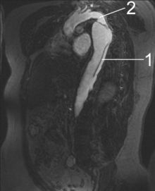 MRT einer Aortendissektion1 Aorta descendens mit Dissektion2 Aortenisthmus