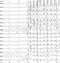 Für eine Absence-Epilepsie typisches Anfallsmuster im EEG