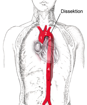 Dissektion der Aorta descendens (3), die nach Abgang der linken Schlüsselbeinarterie beginnt und in die Bauchaorta (4) reicht. Aorta ascendens (1) und Aortenbogen (2) sind nicht betroffen