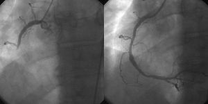 Angiografie der rechten Herzkranzarterie (RCA) bei akutem Hinterwandinfarkt. Li.: RCA verschlossen, Re.: RCA nach Ballondilatation offen