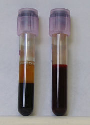 Blutproben, rechts frisch entnommenes Blut, links mit EDTA, einem Gerinnungshemmer, behandeltes Blut. Gut erkennbar ist das hellere Plasma, unter dem sich die zellulären Bestandteile abgesetzt haben.