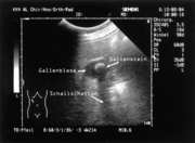 Sonografische Darstellung einer Gallenblase, mit pathologischem Befund (Gallenstein)