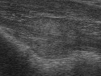 Ultrasonographischer Längsschnitt durch die Prostata eines Hundes mit zentral verlaufender Harnröhre.
