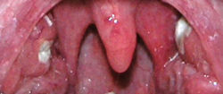Bilaterale Tonsillitis