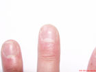 Grübchenbildung an den Fingernägeln