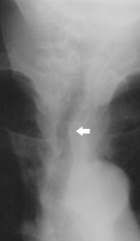 Das Röntgenbild einer ausgeprägten Struma, die die Luftröhre einengt und dadurch zu Atemnot und Stridor führt.
