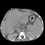 Bild 1. Computertomographie des Abdomens bei Leberzirrhose (Transversalschnitt).