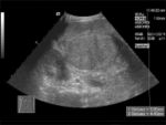 Bild 2. Sonographie des Abdomens bei Leberzirrhose mit nodulärer Formation (Transversalschnitt).