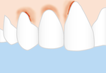 Zahnfleischentzündung