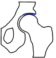 Hüftgelenk – die mechanische Hauptbelastungszone ist blau dargestellt.