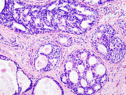 Histologisches Bild eines duktalen Carcinoma in situ der Brust