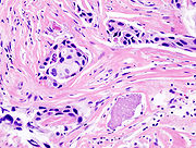 Histologisches Bild eines invasiven duktalen Karzinoms („szirrhöses Karzinom“)