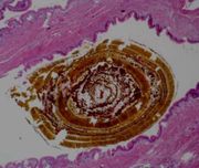Mikroskopische Aufnahme eines Cholesterinpigmentsteines.