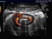 Ultraschallbild bei M. Crohn mit Wandverdickung und verstärkter Durchblutung einer Dünndarmschlinge