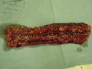 pathologisches Präparat eines operativ entfernten Darmstückes