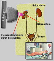 Schematische Funktionsweise der ESWL