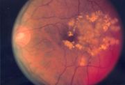 Diabetische Retinopathie