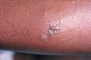 Hautläsionen bei körperweiter Ausbreitung der Gonorrhoe.