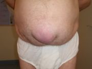 Ein großer Nabelbruch(Hernia umbilicalis)