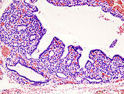 Bei Hyperthyreose das histopathologische Bild einer diffusen Hyperplasie der Schilddrüse.