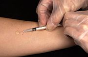 Durchführung des Tuberkulin-Hauttests nach Mendel-Mantoux