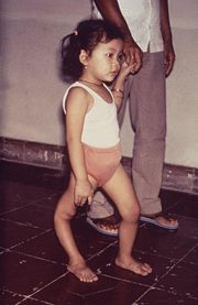Mädchen mit deformiertem rechten Bein als Folge einer Kinderlähmung.