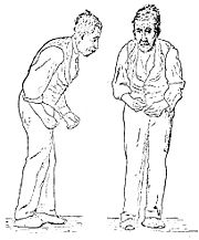 Illustration der Parkinson-Krankheit von Sir William Richard Gowers aus A Manual of Diseases of the Nervous System (Handbuch für Krankheiten des Nervensystems) von 1886