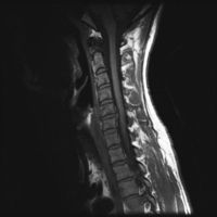 MRT-Aufnahme eines Bandscheibenvorfalls in der Halswirbelsäule, dieser konnte durch Physiotherapie nahezu vollständig geheilt werden