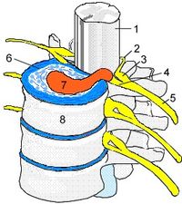 Bandscheibenvorfall: Das vorgefallene Bandscheibengewebe, praktisch immer Anteile der Faserknorpelringe, die um den so genannten Gallertkern herum konzentrisch angeordnet sind, drückt auf den Inhalt der Wirbelkanals und/oder die Nervenwurzel.  1 Rückenmark, 2 Dorsalwurzel, 3 Spinalganglion, 4 Ventralwurzel, 5 Spinalnerv, 6 + 7 Bandscheibe: 6 Faserring, 7 Degenerierter Gallertkern, dazwischen die Knorpelringe, 8 Wirbelkörper