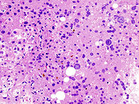 Histologisches Bild (die bräunlichen Tropfen sind Galleeinschlüsse)