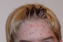 Acne vulgaris bei einem 14-jährigen Jungen.