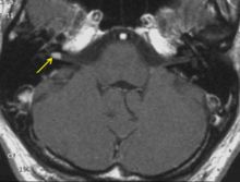Akustikusneurinom im MRT-Bild (Pfeil)