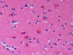 Histologie eines frischen Infarktes mit Gewebeabblassung und akut geschädigten Nervenzellen (Hämatoxylin-Eosin-Färbung, Originalvergrößerung 1:400